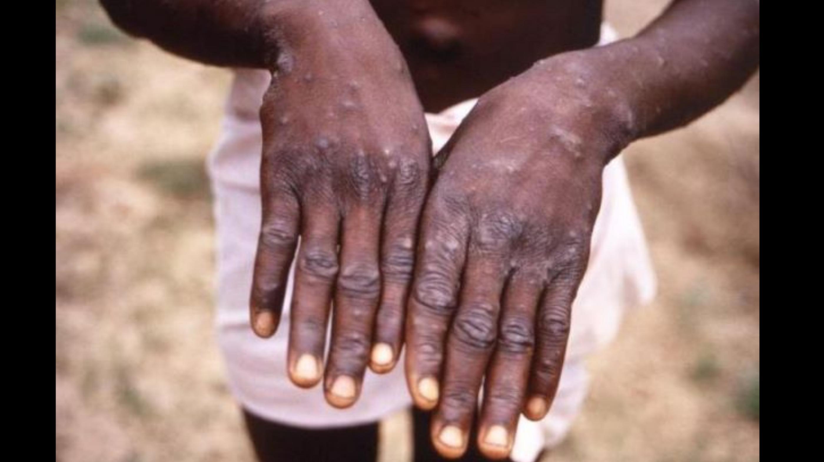 pasien-monkeypox-di-republik-demokratik-kongo-saat-wabah-pada-tahun-1997-2.jpg