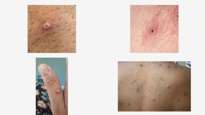 penampakan-cacar-monyet-atau-monkeypox.jpg
