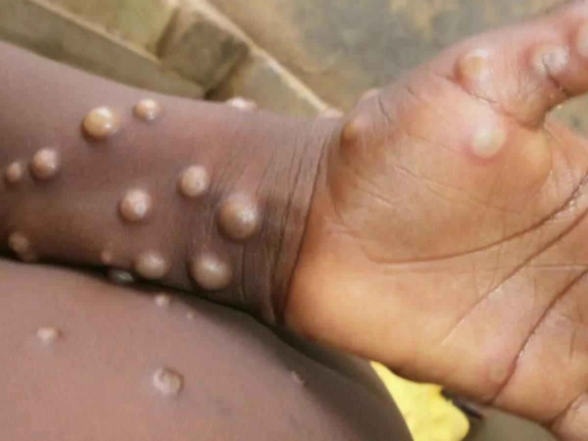 Otoritas Inggris Minta Penderita Monkeypox Tidak Lakukan Hubungan Badan Saat Kasus Meningkat