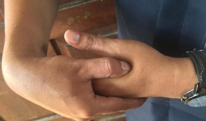 Ada Anggapan Pijatan Jadi Sebab Kanker Tulang? Ini Kata Dokter Ortopedi
