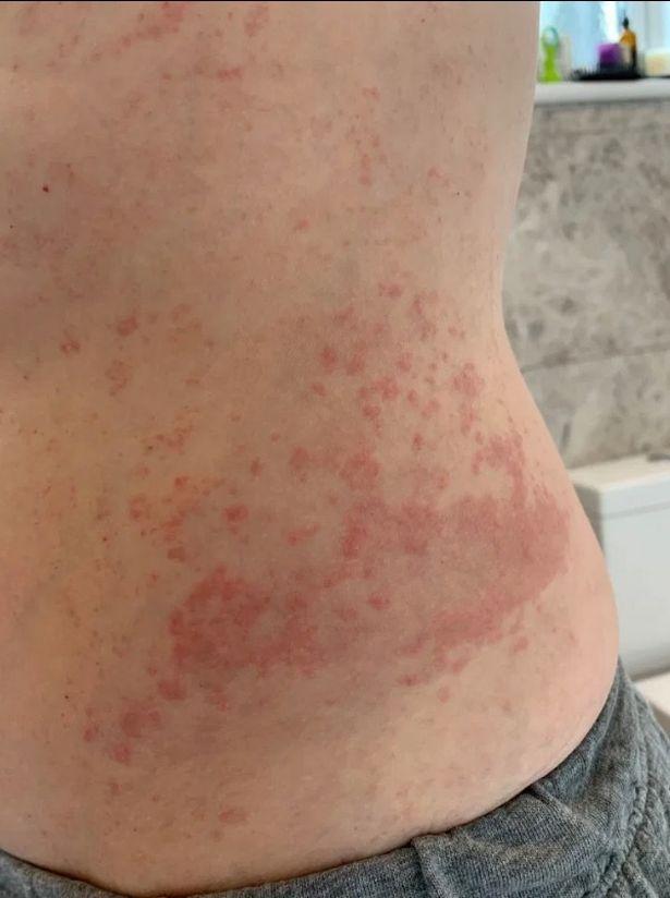 ‘Prickly heat’ atau chickenpox-type rash 