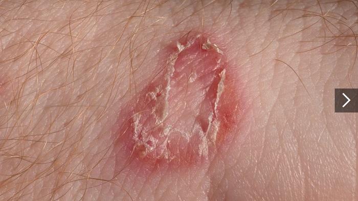 ringworm-atau-kurap-healthline.jpg