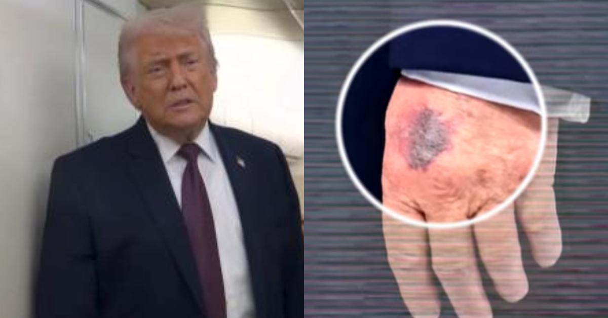 tangan-trump-memar-jadi-sorotan.jpg