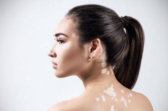 vitiligo-ilustrasi.jpg