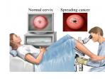 20140228_060730_pap-smear-kanker-serviks.jpg