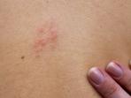 20140624_144718_herpes-zoster.jpg