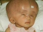 20140819_213053_penderita-hydrocephalus.jpg