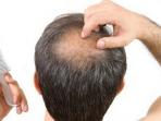 20140826_162241_rambut-rontok-dan-kebotakan.jpg