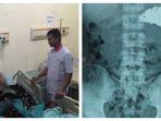 70-paku-berukuran-besar-bersarang-di-perut-sh-22-warga-indramayu.jpg