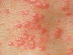 8-cara-menyembuhkan-herpes.jpg
