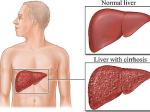 Hepatitis-B.jpg