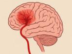 Mengenal Digital Subtraction Angiography, Teknologi untuk Melihat Jalur Macet di Pembuluh Darah Otak