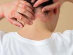 Penyakit-autoimun-psoriasis.jpg