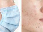 acne-mekanic-adalah-jerawat-yang-timbul-karena-gesekan.jpg