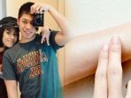 adara-taista-dan-kanker-kulit_20180520_082704.jpg