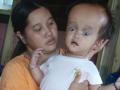 ahmad-muthi-hydrocephalus.jpg