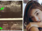 VIRAL Nasib Pilu Gadis Ini Akibat Tak Pernah Sarapan, Mau Muntah Tapi Susah, Jangan Sepelekan!