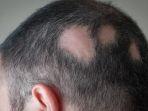 alopecia11.jpg