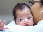 anak-penderita-bibir-sumbing.jpg