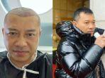 anang-hermansyah-yang-lakukan-transplantasi-rambut.jpg