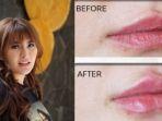 angela-filler-bibir.jpg