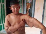 aria-permana-bocah-obesitas-akan-jalani-operasi-lagi.jpg