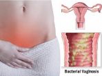 bacterial-vaginosis_20170309_184313.jpg