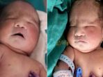 bayi-dengan-sindrom-ikan-duyung_20180524_182024.jpg