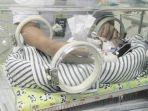 bayi-kembar-4-tangan-dan-kaki-di-ruang-nicu-rsup-sanglah.jpg