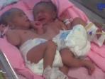 bayi-kembar-siam_20160330_182824.jpg