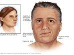 bells-palsy-11.jpg