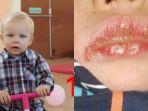 bibir-bayi-bengkak-herpes-8.jpg
