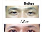 blepharoplasty_20170406_200309.jpg
