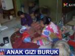 bocah-gizi-buruk-di-jakarta_20151110_220204.jpg