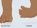 club-foot-44646.jpg