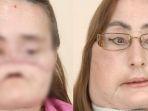 connie-culp-penerima-transplantasi-wajah.jpg