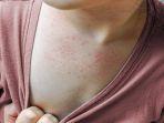 epidermolisis-bulosa.jpg