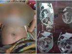 fakta-di-balik-viral-bayi-laki-laki-hamil-di-sumbar-kondisi-janin-hidup-awalnya-dikira-kembung.jpg