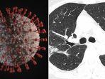 foto-paru-paru-rusak-milik-penderita-virus-corona-kronis.jpg