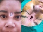 gagal-operasi-hidung_20180103_142918.jpg