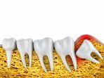 gigi-bungsu-tumbuh-nyeri-wisdom-teeth.jpg