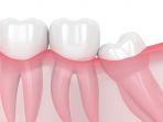 gigi-bungsu-wisdom-teeth.jpg