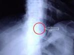 gigi-palsu-x-ray_20151005_092858.jpg