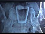 hasil-foto-rotgen-tubuh-warga-jember-yang-berisi-gelas-pecah.jpg