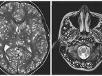 hasil-pindai-mri-otak-pasien-dengan-ratusan-cacing-pita-bersarang-di-otaknya.jpg
