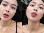 Leher Wika Salim Memar Dikira Bekas Cupang, Klarifikasinya Tak Dipercaya, Netizen: Kena Patil Lele