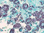 histoplasmosis-2.jpg