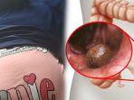 ibu-kantin-kena-tumor-usus.jpg