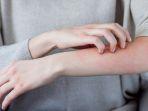 ilustrasi-alergi-sumber-shutterstock.jpg