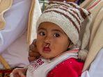 ilustrasi-bibir-sumbing-shutterstock.jpg